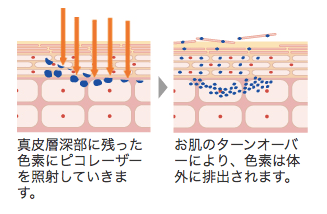 ピコレーザーで破壊